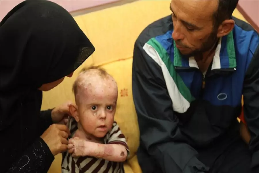 هيئة الإغاثة التركية تشرف على علاج طفل مصاب بـ "مرض الفقاع" بعد إخراجه من إدلب إلى تركيا