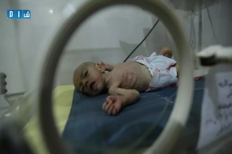 ليس بالقصف وحده .. وباء سوء التغذية يفتك بأجساد الأطفال شمال سوريا