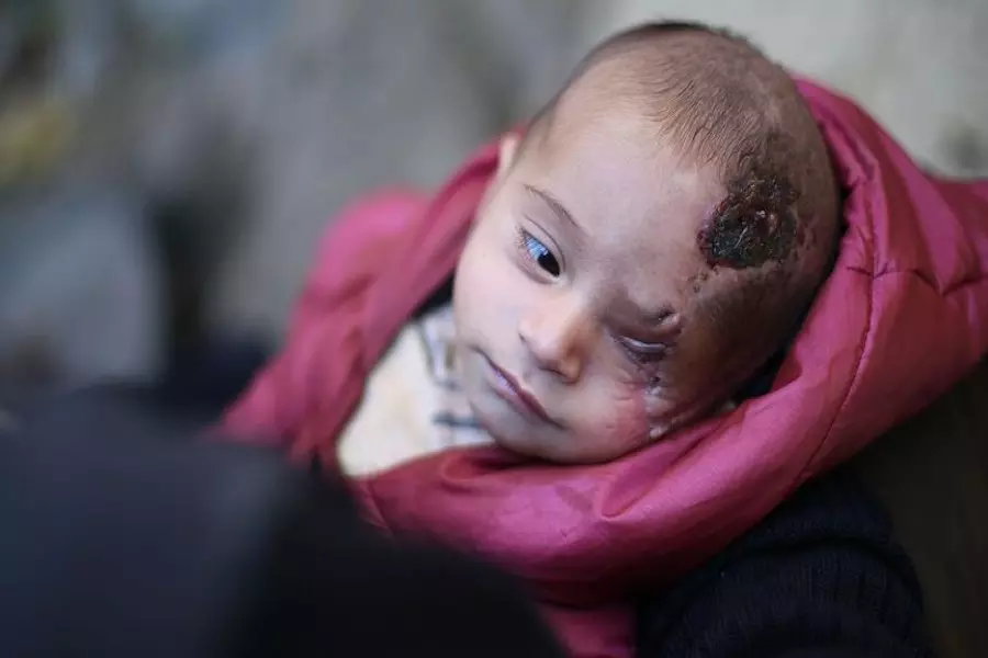 كيف تم إنقاذ الرضيع كريم الذي اغتال نظام الأسد عينه وأمه ..!؟