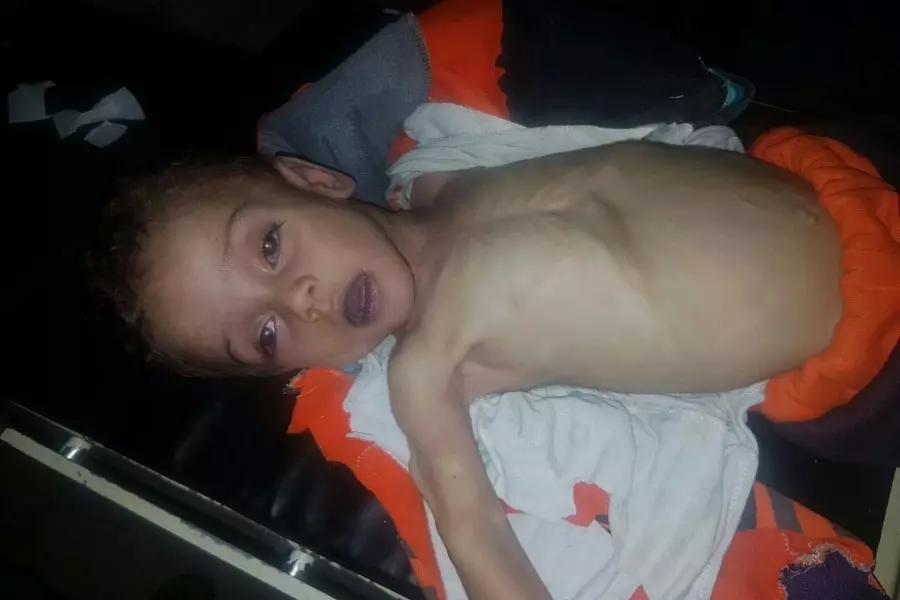الغوطة الشرقية تسجل وفاة الطفل "محمد عبد السلام" بسبب نقص التغذية
