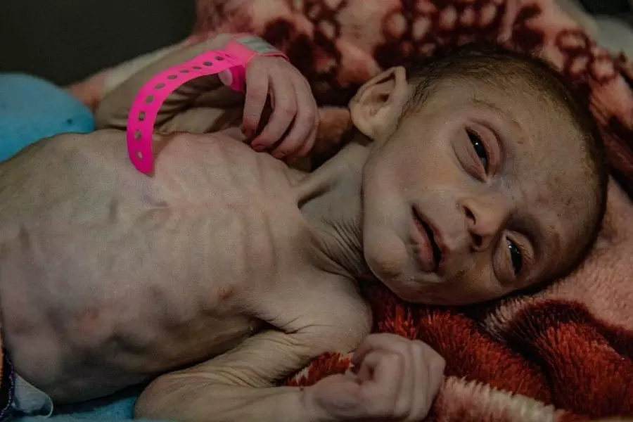 وفاة طفل عراقي بسبب سوء التغذية ونقص الرعاية الصحية بمخيم الهول