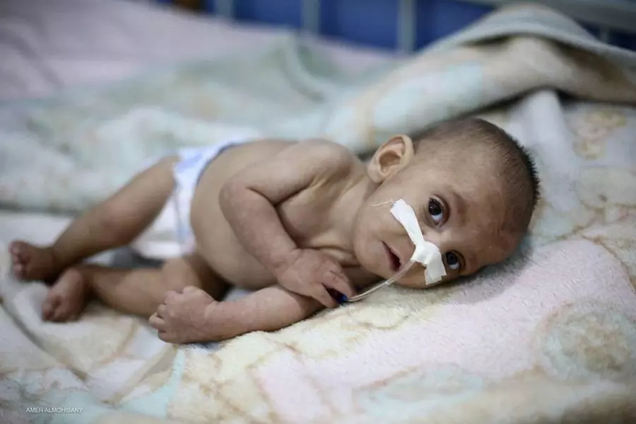 وفاة الطفل "حسين مقدوح" سبعة أشهر جراء نقص التغذية وضعف الرعاية الصحية