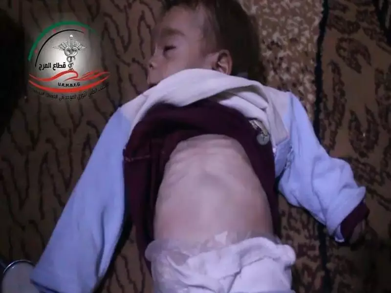 الطفل براء ... ضحية جديدة بين أنياب الجوع و الحصار في الغوطة الشرقية