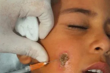 قرية جبالا تسجل إصابات باللشمانيا وسط نقص الرعاية الصحية